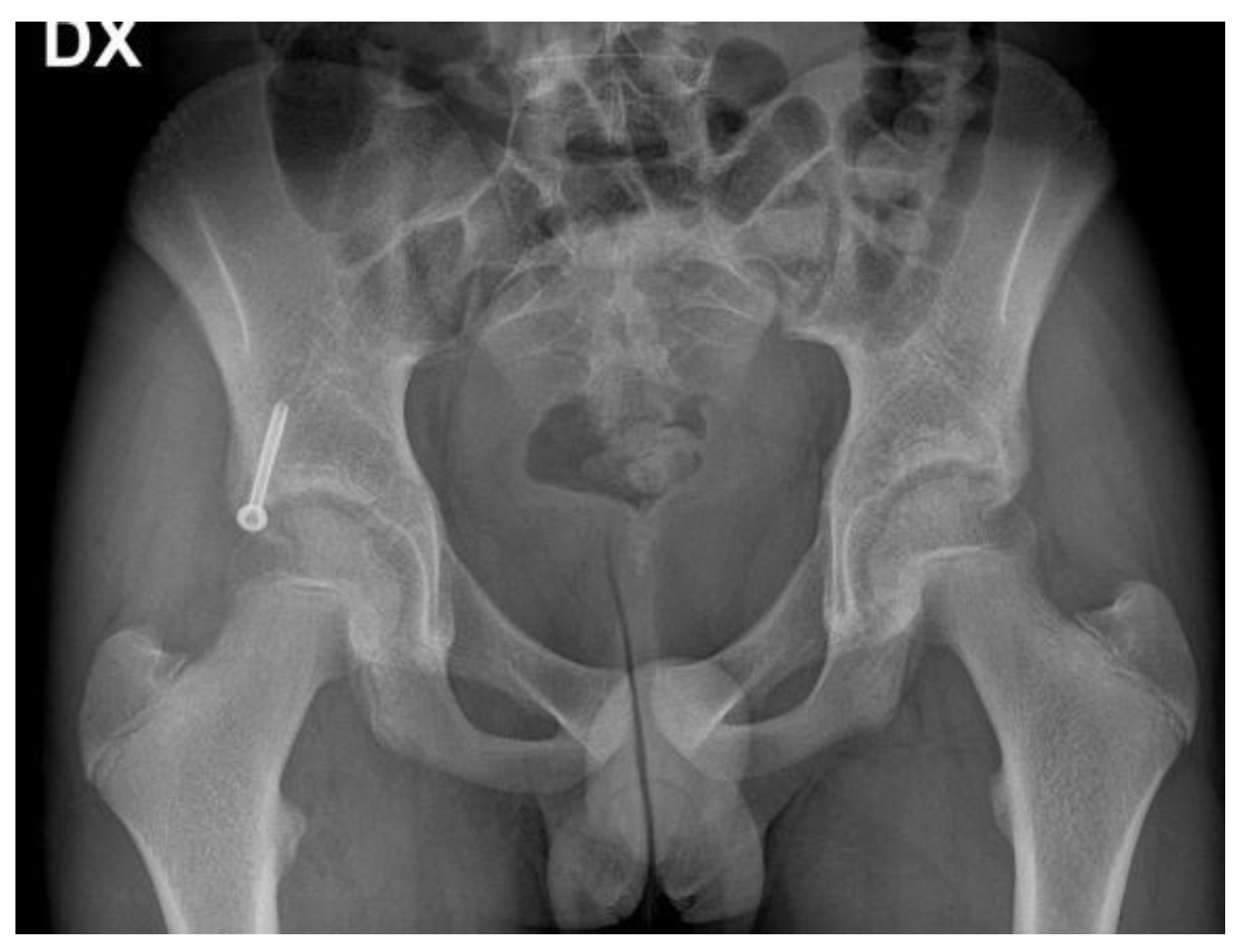 Classification of Pelvic Ring Fracture and Dislocation | SpringerLink