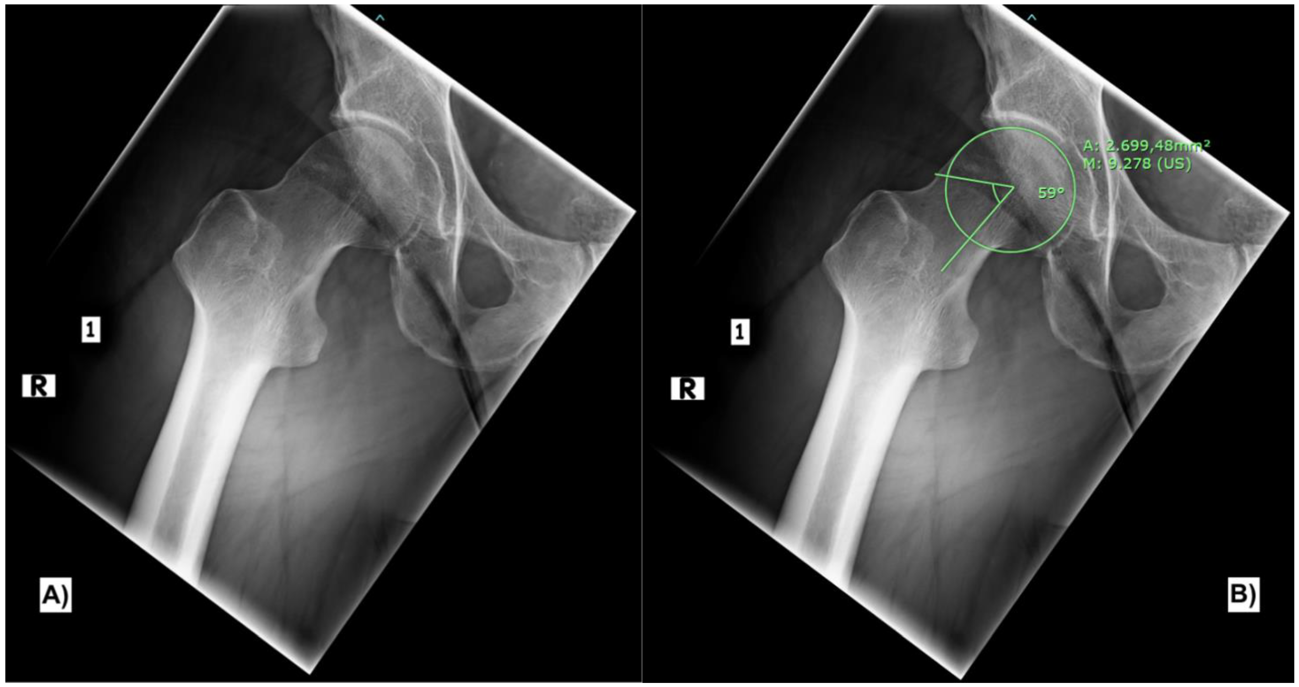 Acute Traumatic Tear Of The Gluteus Medius And Gluteu vrogue.co