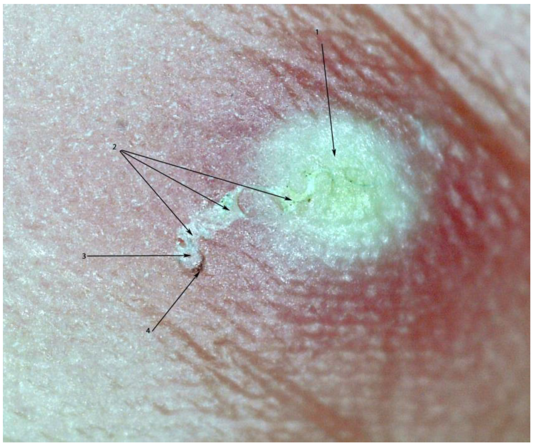 TropicalMed | Free Full-Text | In Situ Diagnosis of Scabies Using Handheld Digital Microscope in Resource-Poor Settings—A Proof-of-Principle Study in the Amazon Lowland Colombia