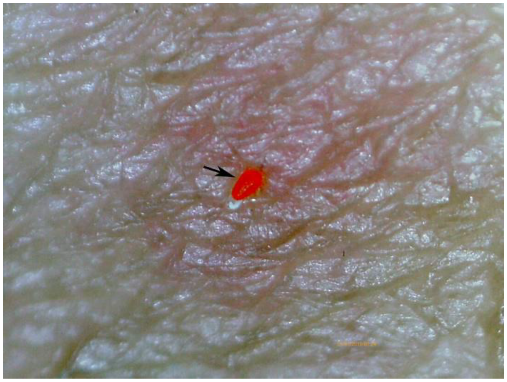 Scabies mite cheap