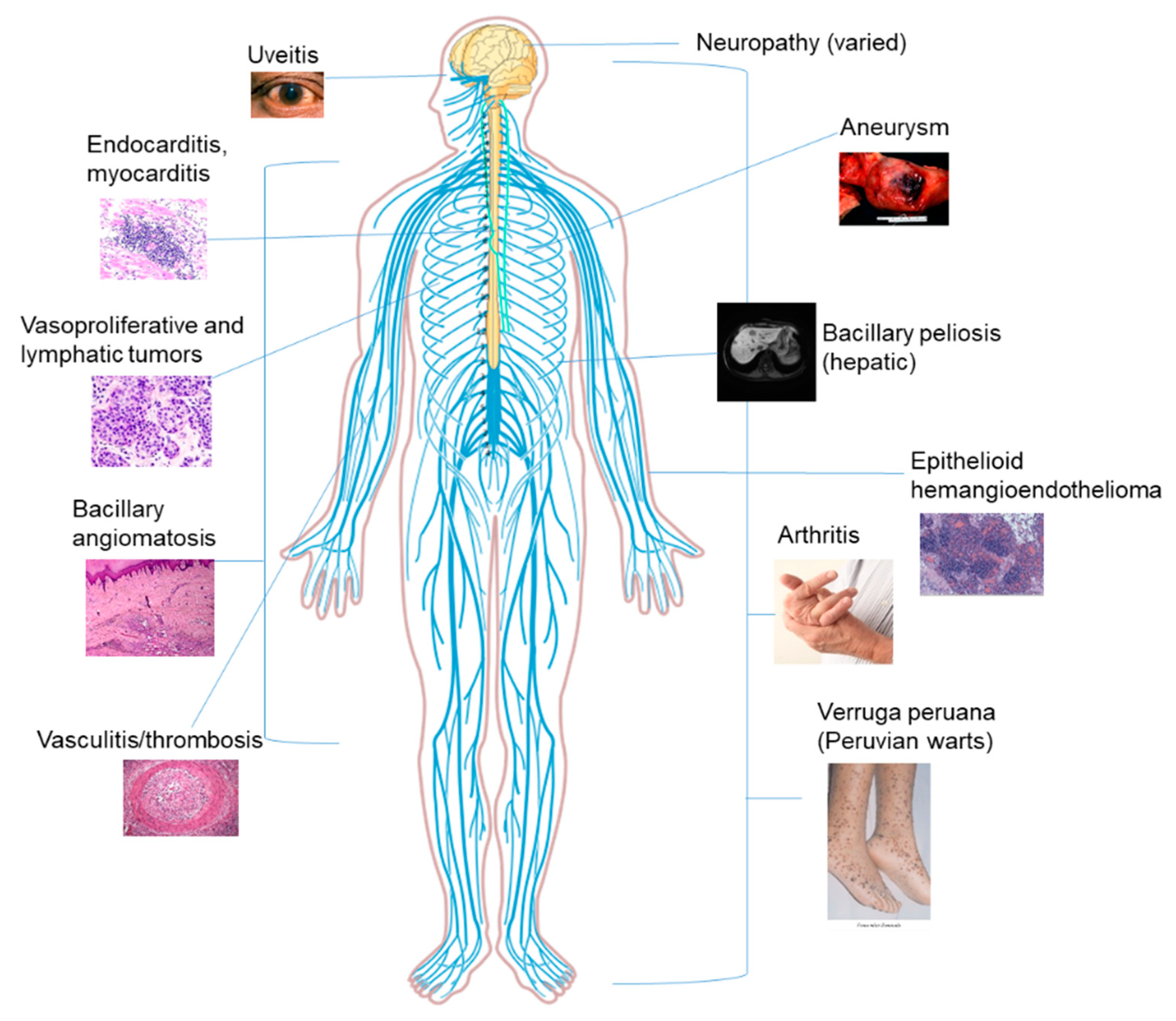 vesiculitis és merevedés lefelé hajlított pénisz