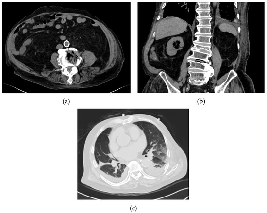 Strongyloides Hyperinfection Associated with Enterococcus