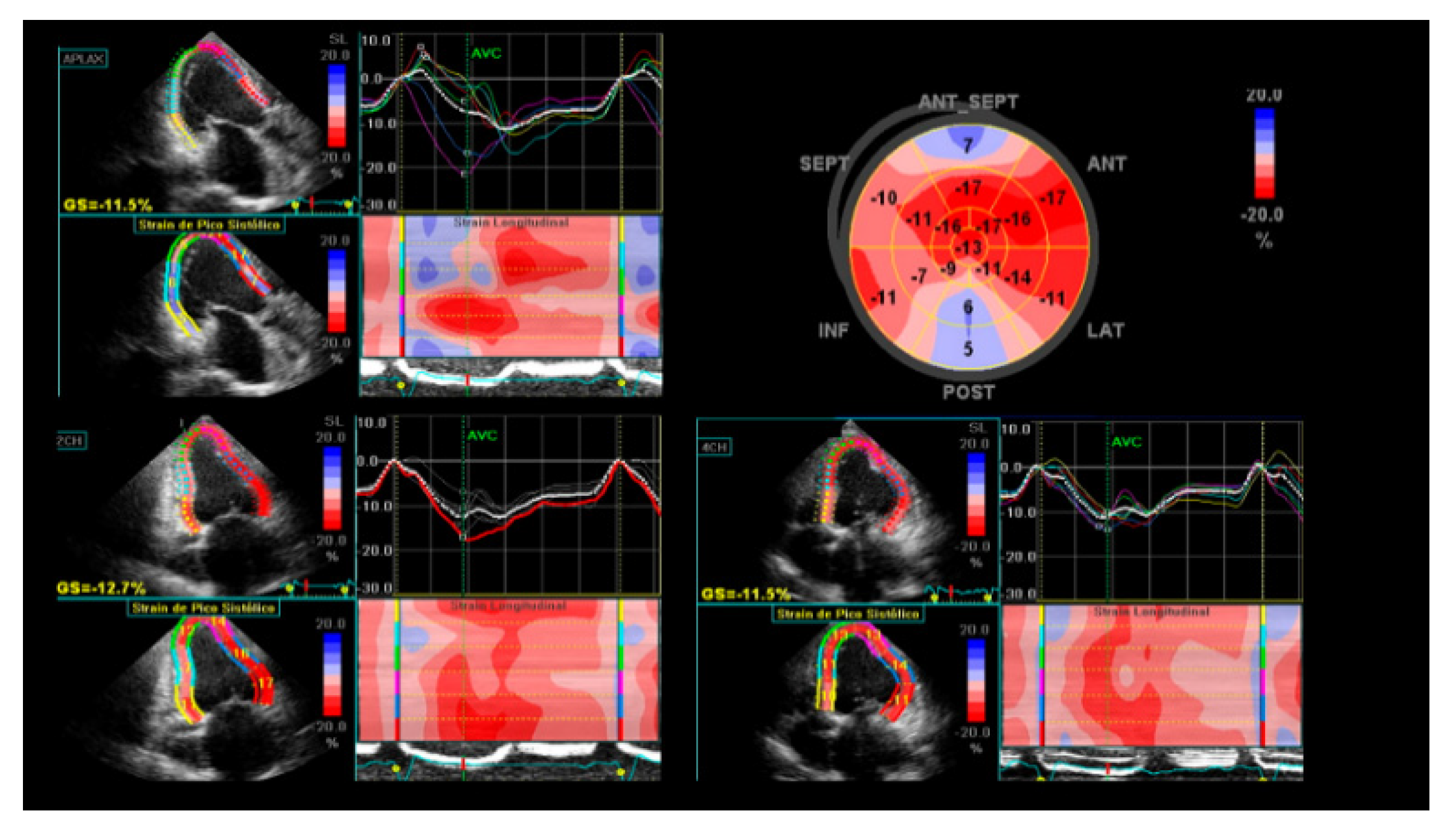 Strain Echocardiography in Acute Cardiovascular Diseases - The Western  Journal of Emergency Medicine