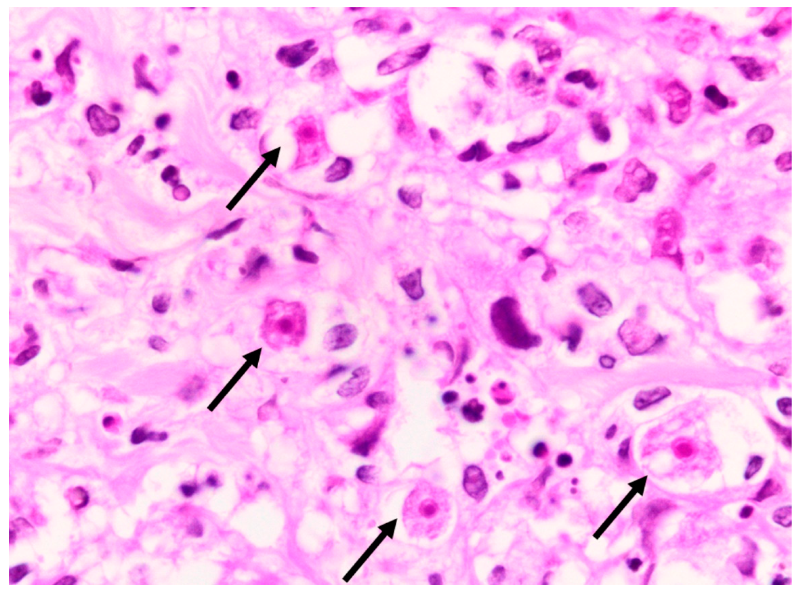 TropicalMed | Free Full-Text | Clinical Improvement of Disseminated  Acanthamoeba Infection in a Patient with Advanced HIV Using a  Non-Miltefosine-Based Treatment Regimen in a Low-Resource Setting