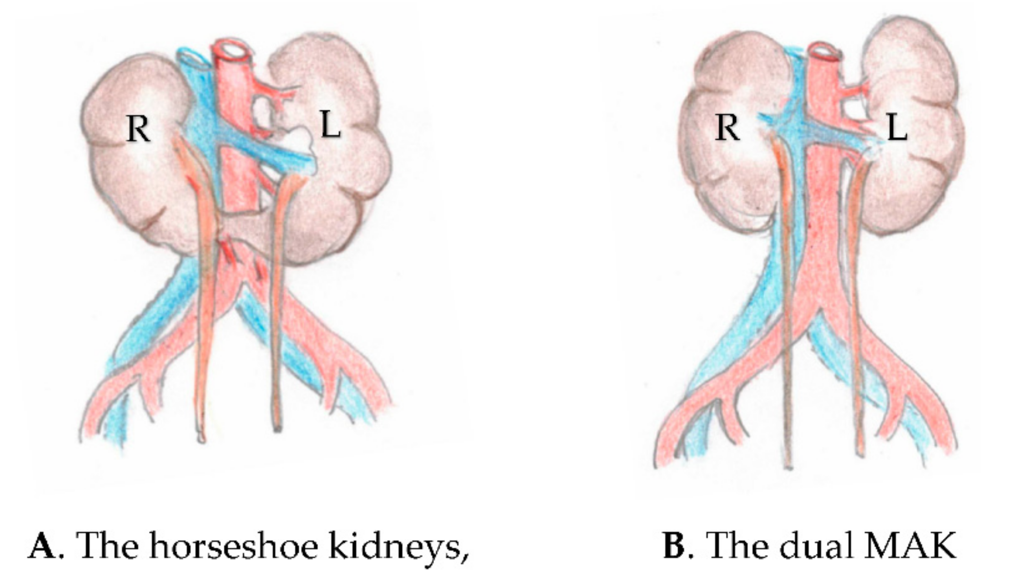 Uro Free FullText Transplantation of the Horseshoe Kidneys A