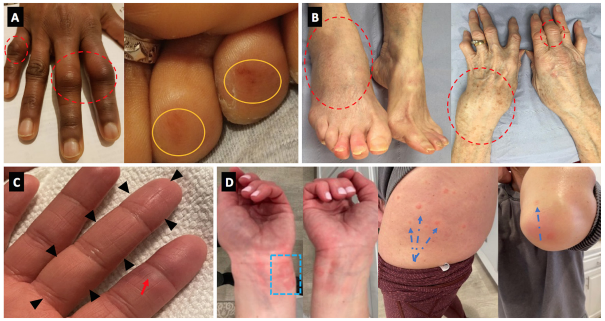 Covid Toe After Vaccine