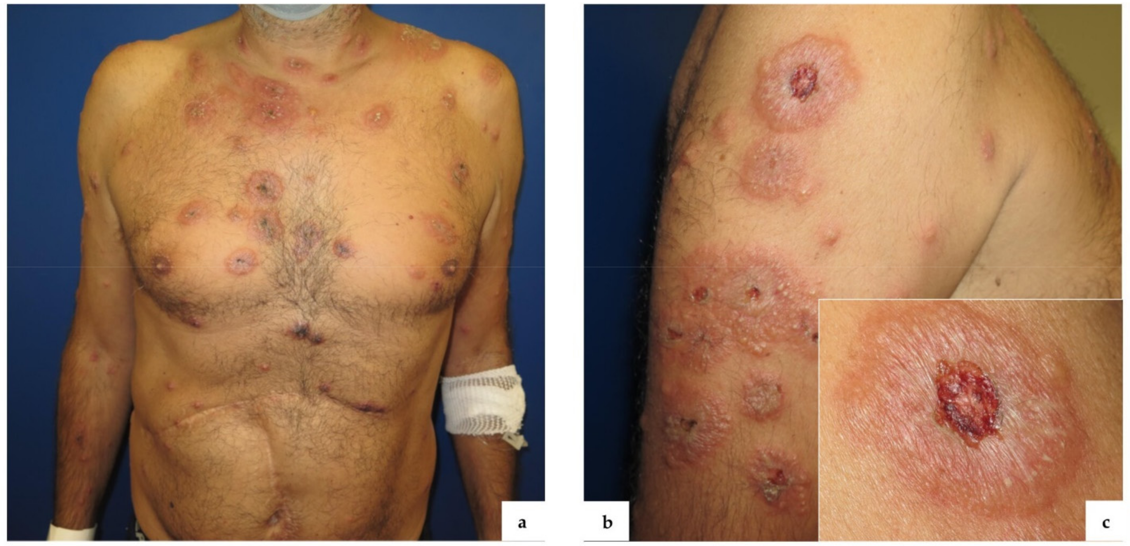 Vaccines | Free Full-Text | Sweet Syndrome Following SARS-CoV2 Vaccination