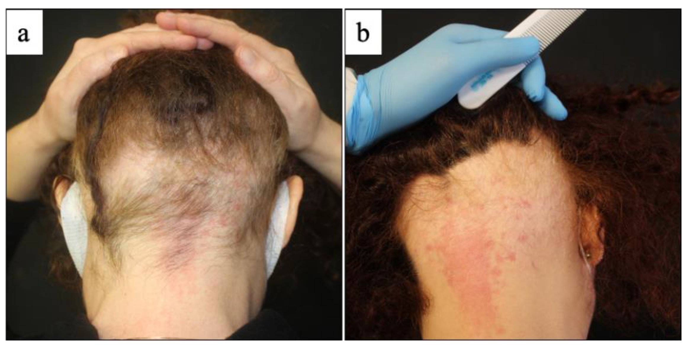Vaccines | Free Full-Text | Alopecia Areata Occurring after COVID-19 Vaccination: A Single-Center, Cross-Sectional Study Vaccines | Free Full-Text | Alopecia Areata Occurring after COVID-19 Vaccination: A Single-Center, Cross-Sectional Study
