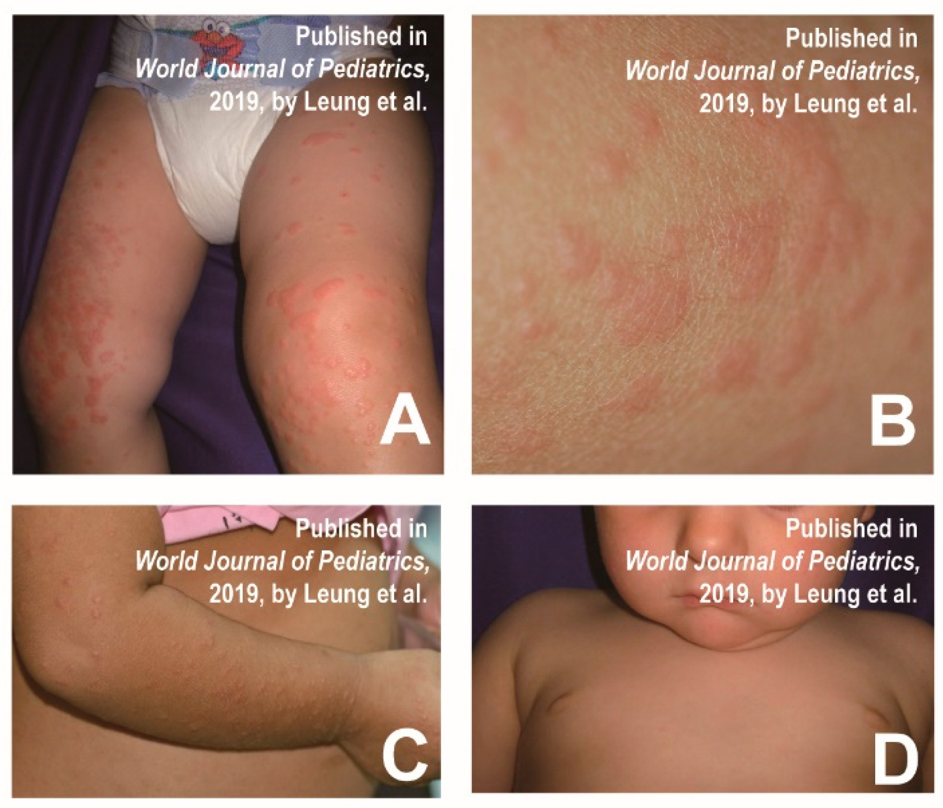 Hand Foot Mouth Rash Causes Infoupdate