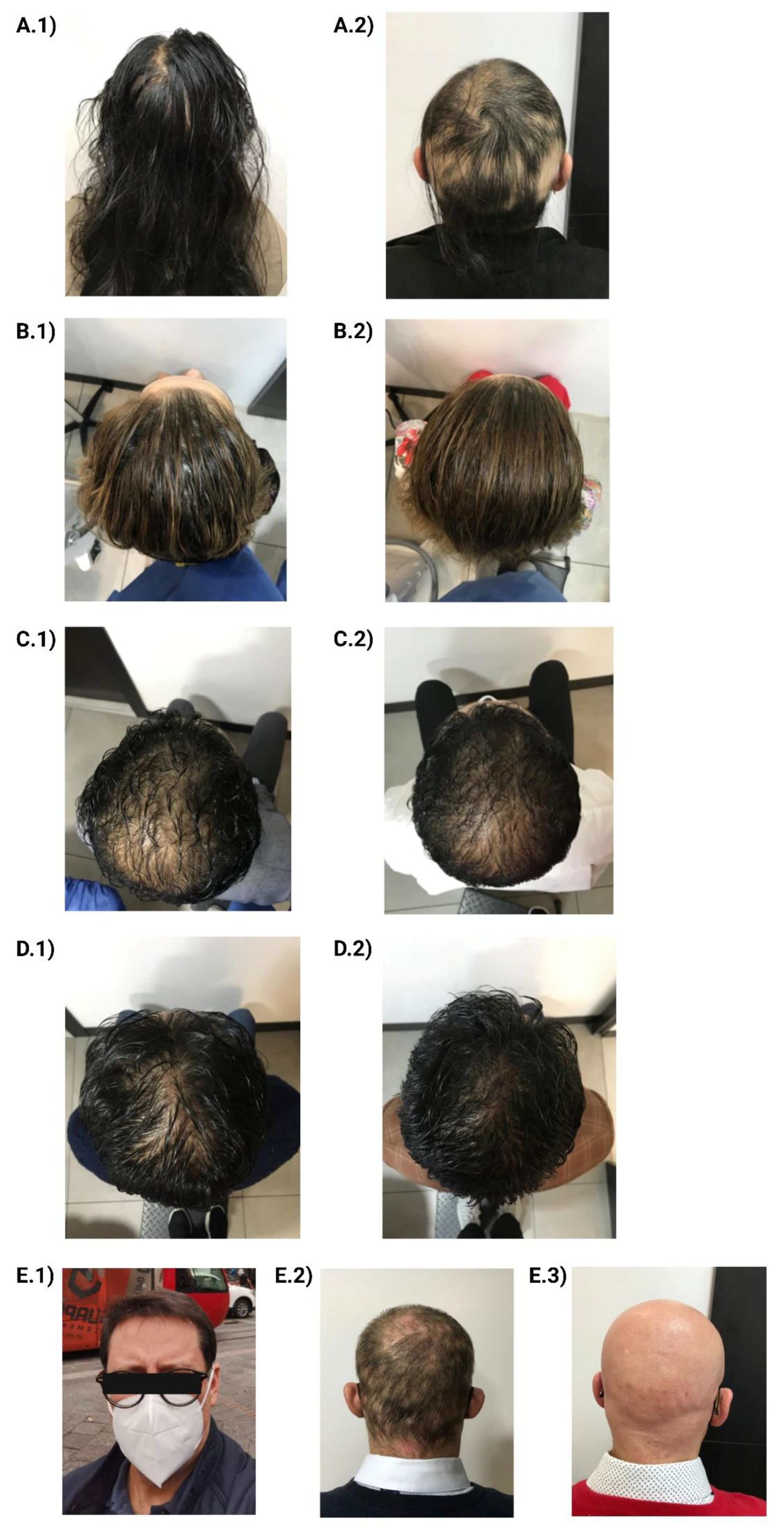 Vaccines | Free Full-Text | A Case Series and Literature Review of Telogen  Effluvium and Alopecia Universalis after the Administration of a  Heterologous COVID-19 Vaccine Scheme
