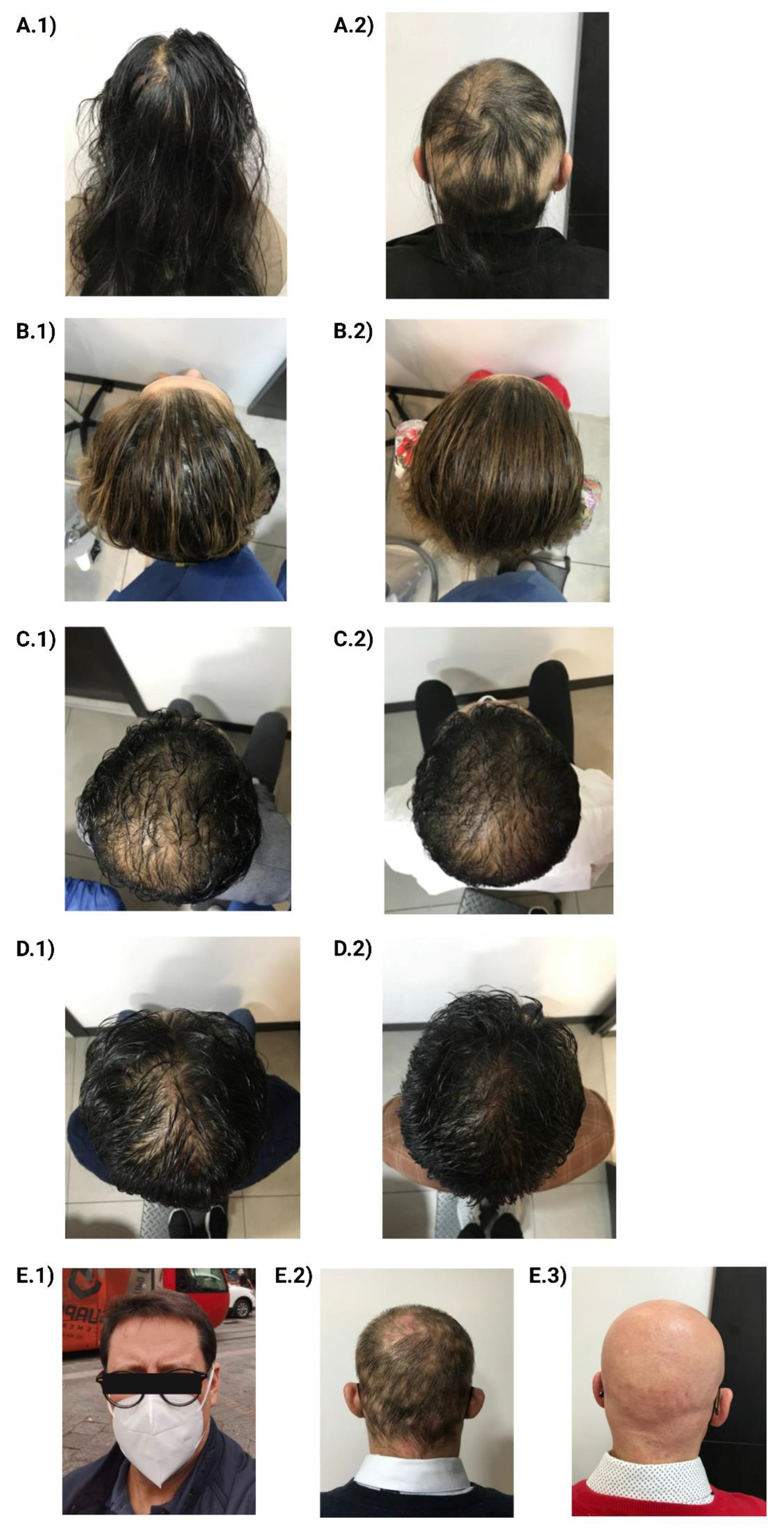 Telogen Effluvium Warrior How I Overcame Chronic Post Viral Hair Loss  eBook  Simi Rita  Amazonin Kindle Store