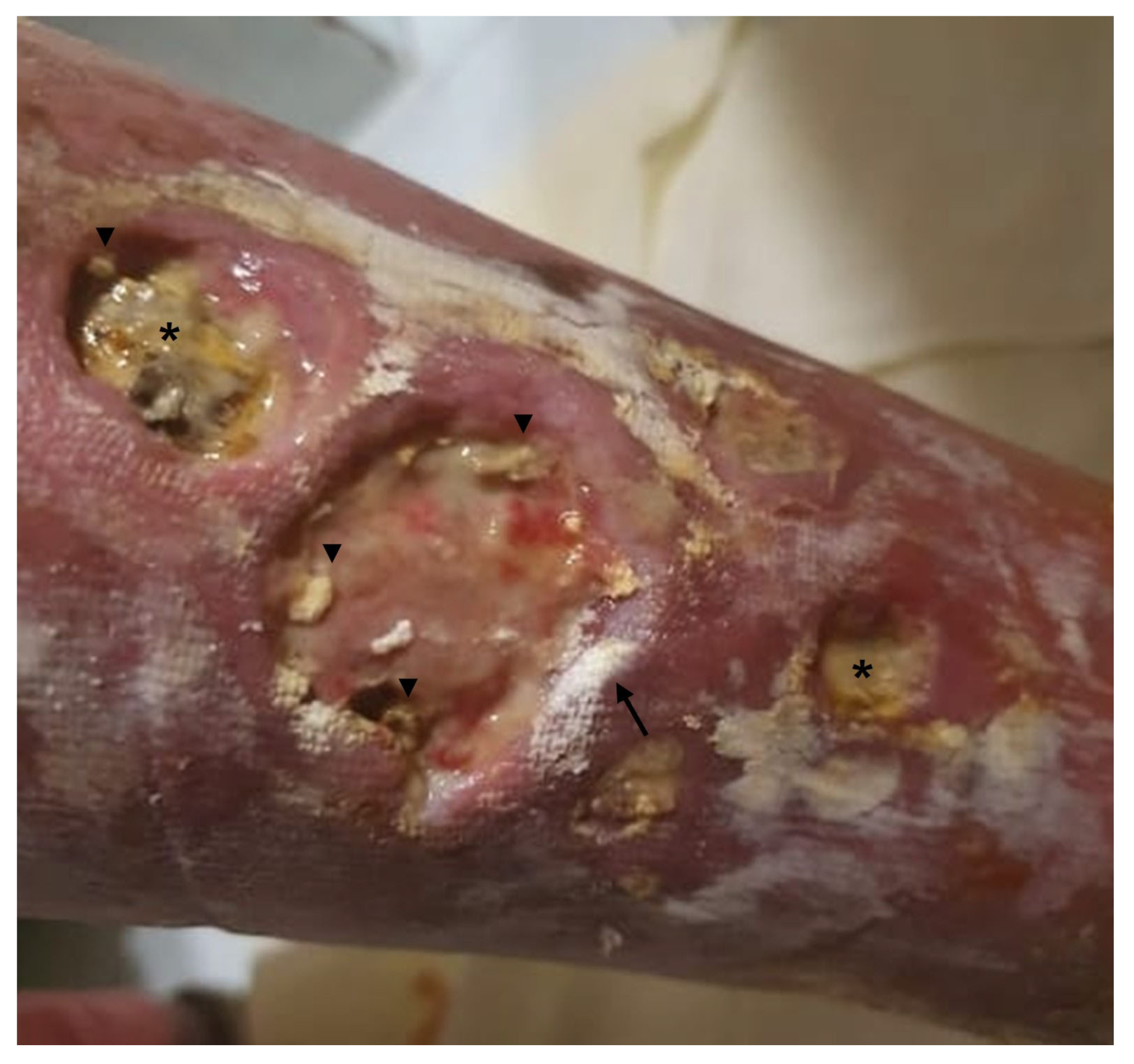 Vaccines | Free Full-Text | Calcinosis Cutis and Calciphylaxis in  Autoimmune Connective Tissue Diseases