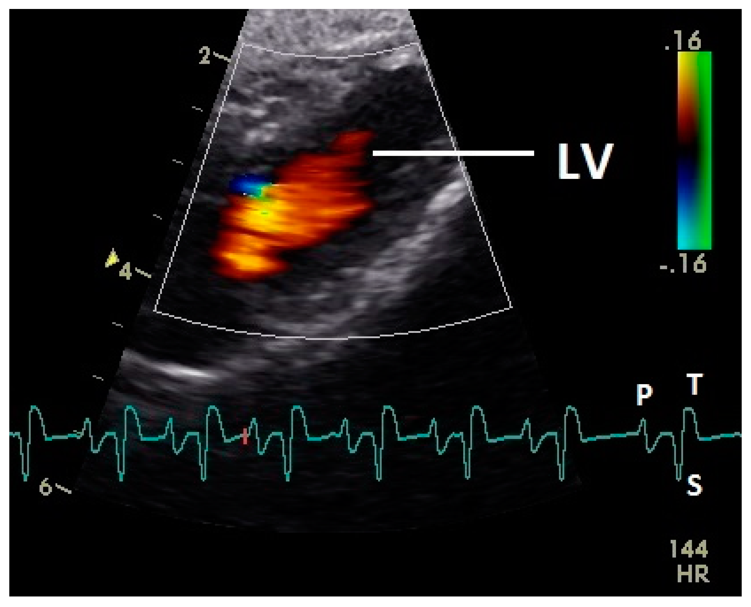 What Do The Colors Mean On Doppler Ultrasound