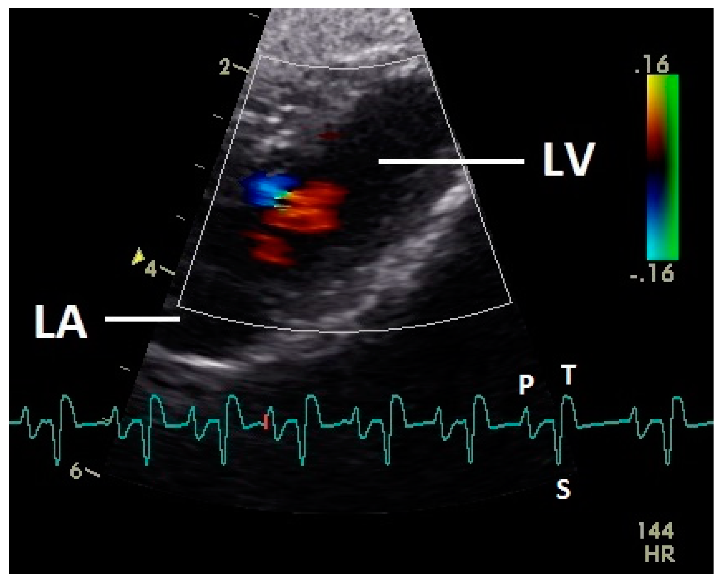 What Do The Colors Mean On Doppler Ultrasound Scan