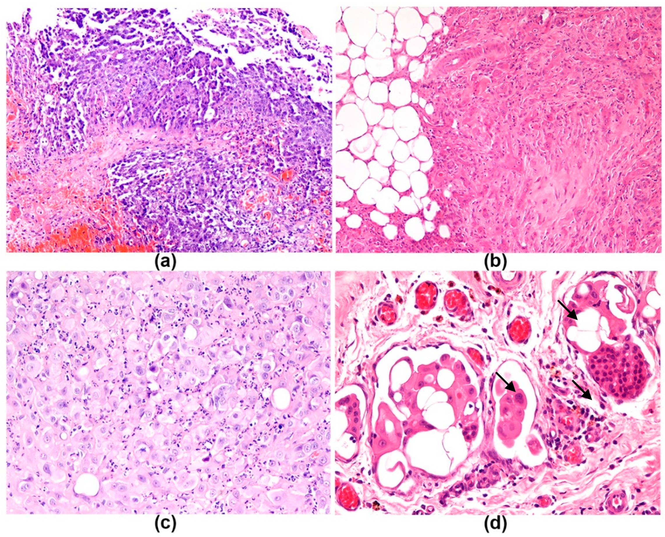 what is squamous cell carcinoma in situ