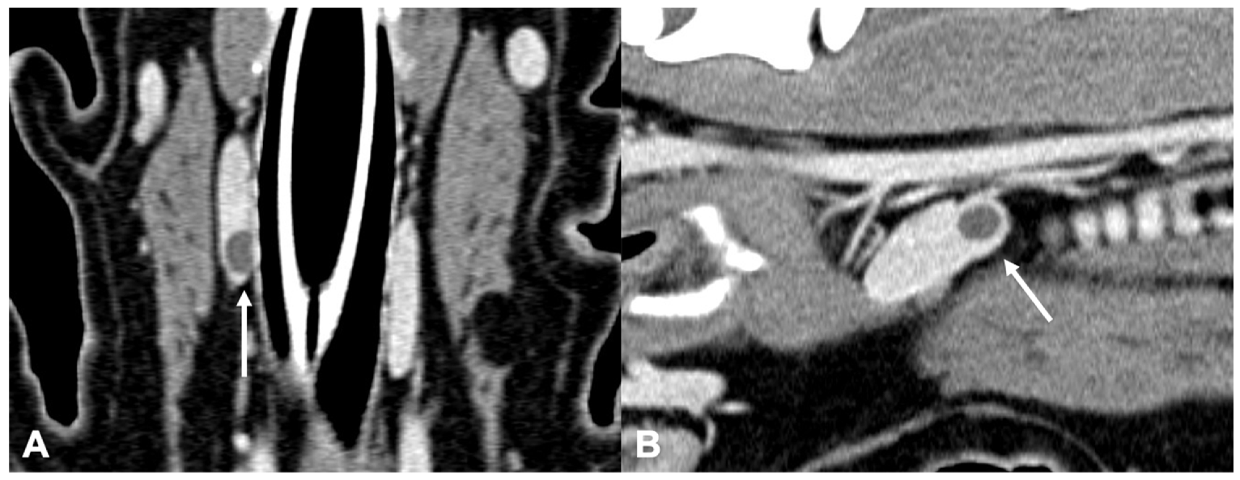 What Happens If Hyperparathyroidism Is Left Untreated In Dogs