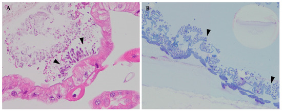 giardiasis, amíg tart)