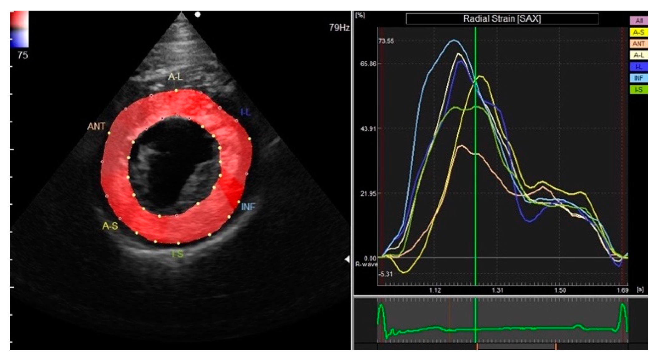 Comprehensive Left Ventricular Mechanics Analysis by Speckle Tracking  Echocardiography in COVID-19
