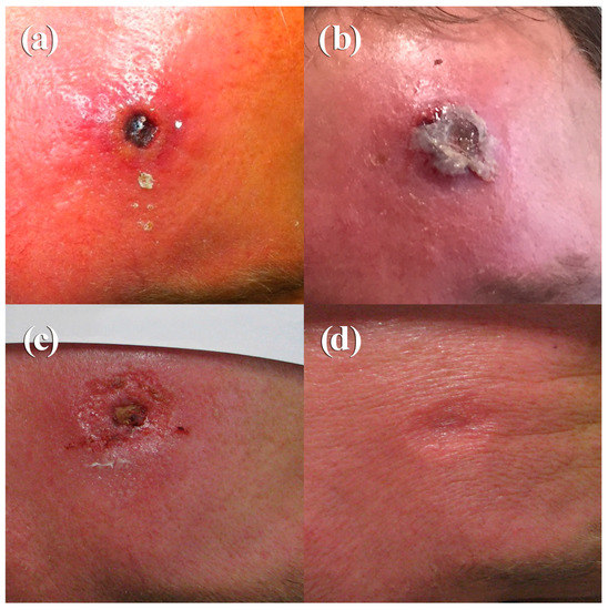Viruses | Free Full-Text | Two Distinct Clinical Courses of Human