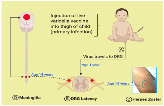 Viruses Free Full Text Twelve Children With Varicella Vaccine Meningitis Neuropathogenesis Of Reactivated Live Attenuated Varicella Vaccine Virus Html