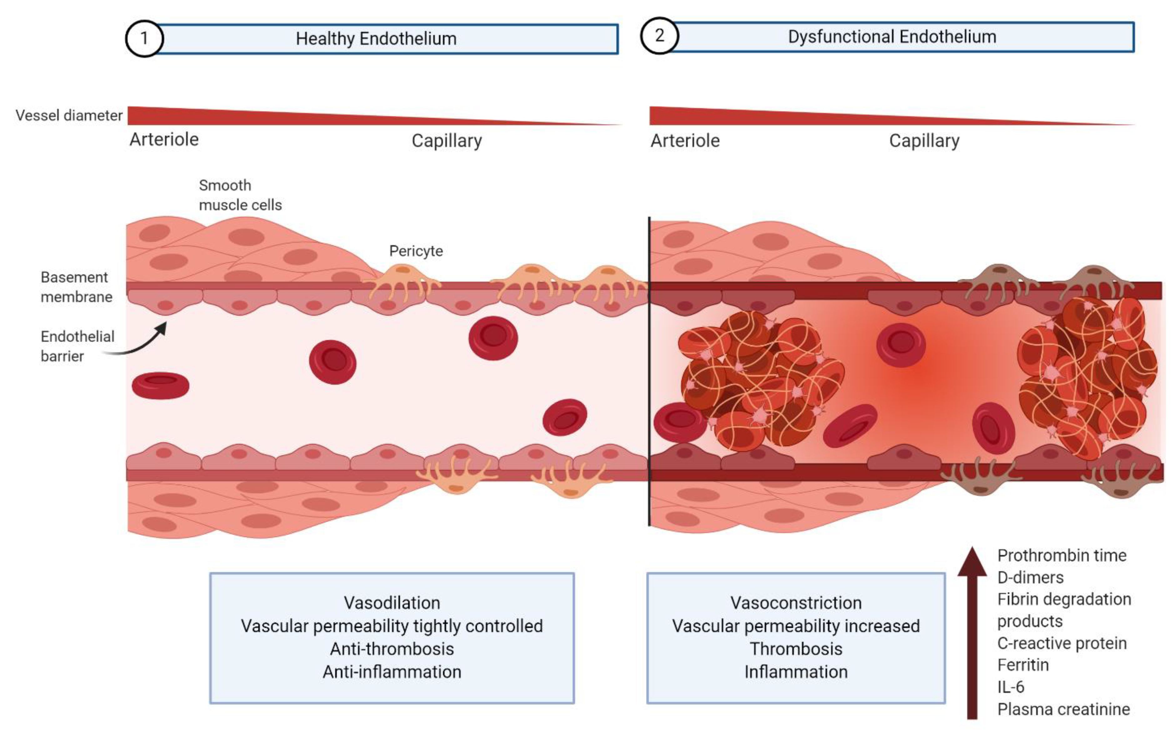 Endothelial cell infection and endotheliitis in COVID-19 - The Lancet