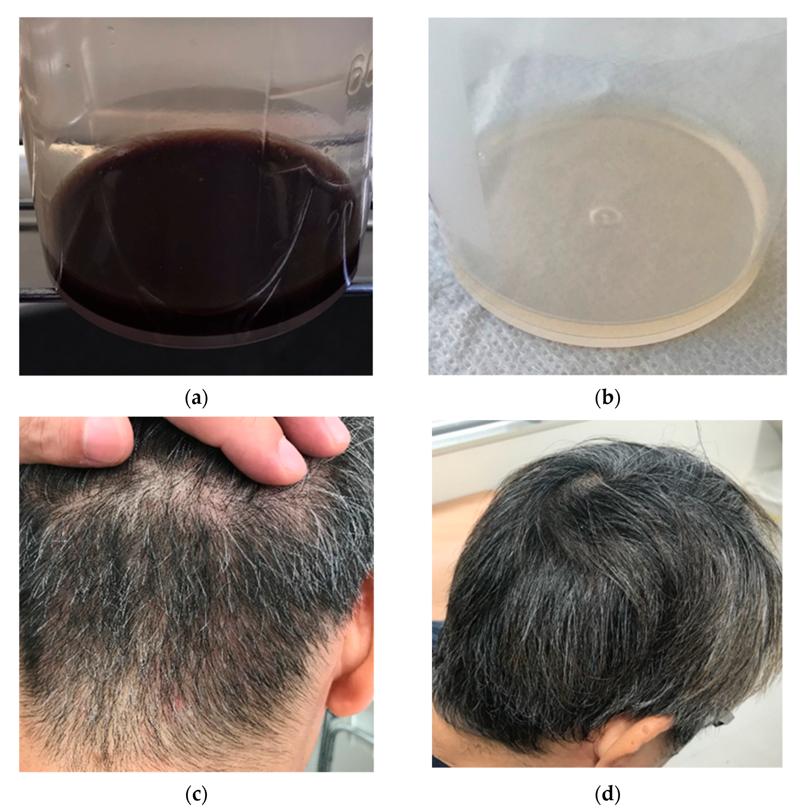 Viruses | Free Full-Text | Residual and Late Onset Symptoms Appeared in a Patient with Severe Fever with Thrombocytopenia in a Convalescence Stage Viruses | Free Full-Text | Residual and Late Onset Symptoms Appeared in a Patient with Severe Fever with Thrombocytopenia in a Convalescence Stage