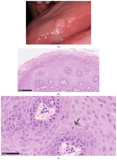 papilloma vírus alsó ajak
