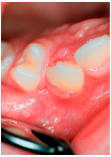 squamous papilloma syndrome tratarea agrafelor și a viermilor