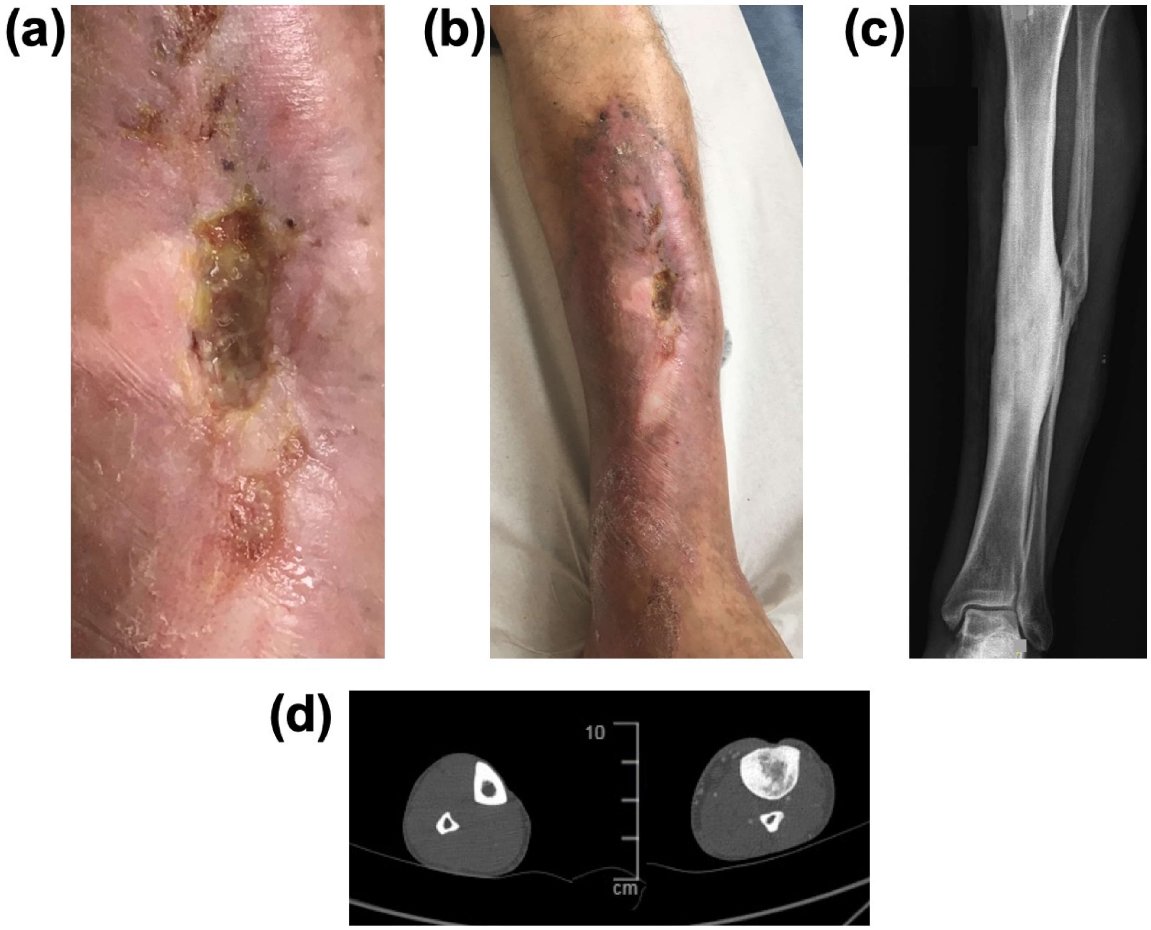 flegmon varicose