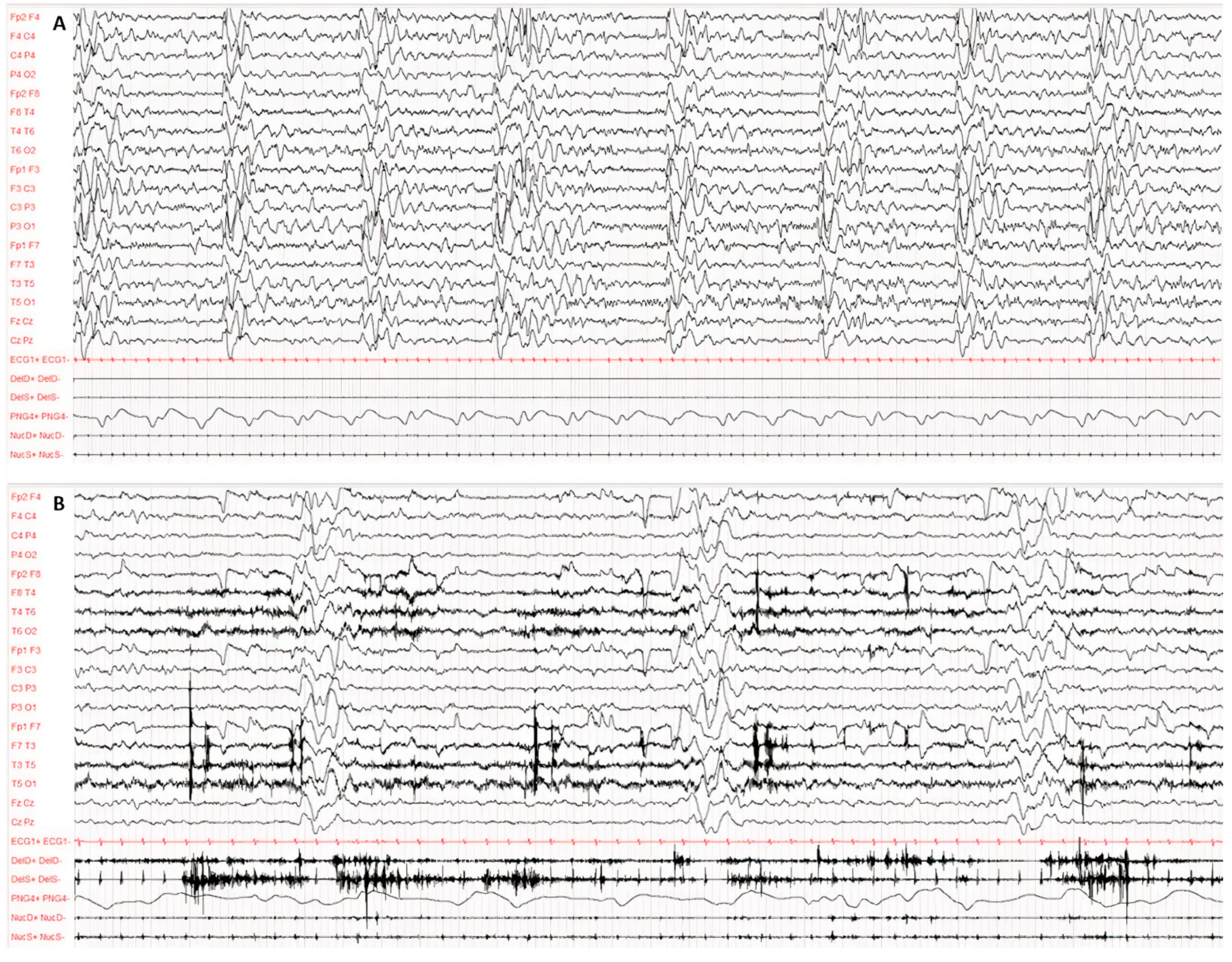 Viruses | Free Full-Text | Subacute Sclerosing Panencephalitis in Children:  The Archetype of Non-Vaccination | HTML