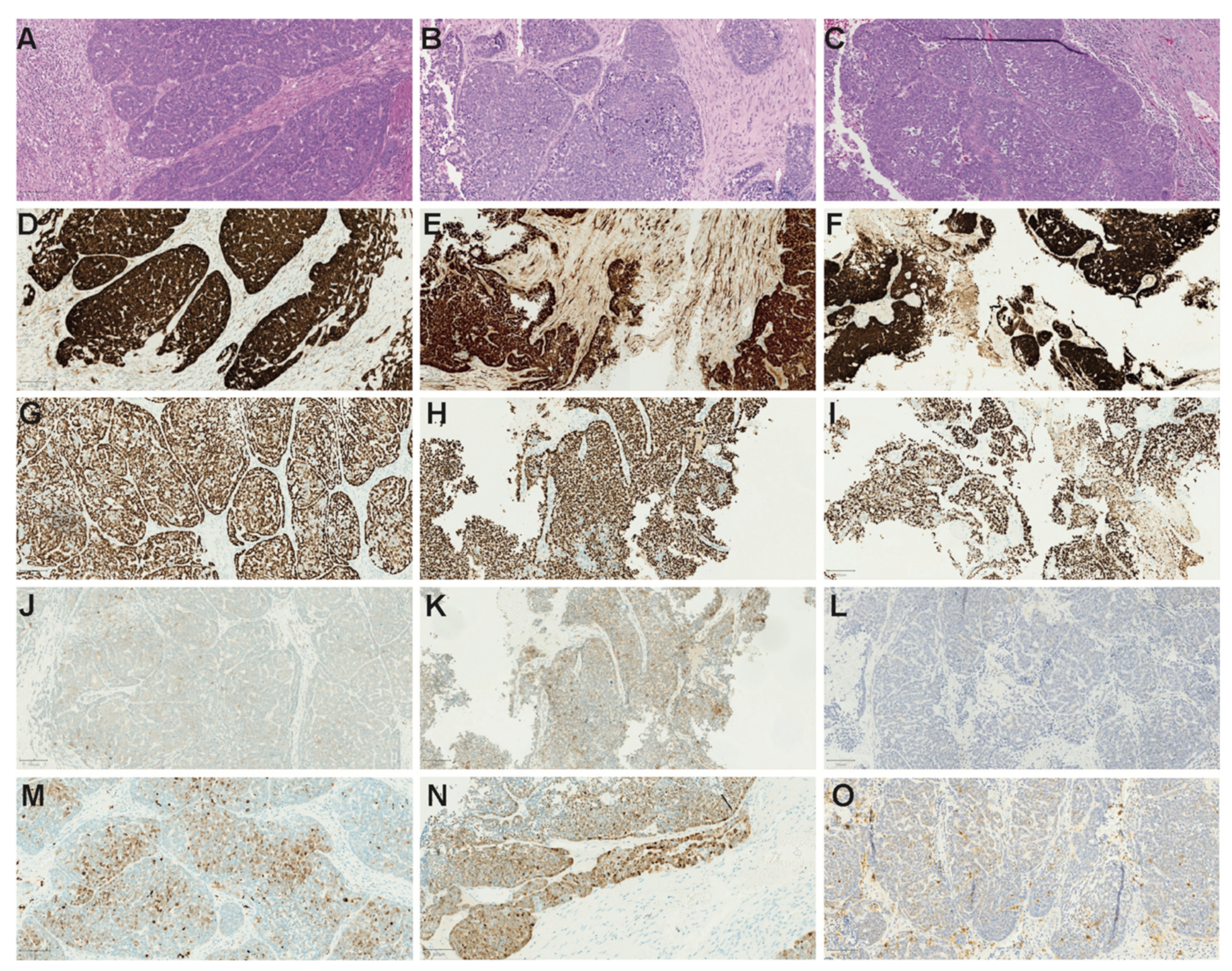 hx papilloma icd 10