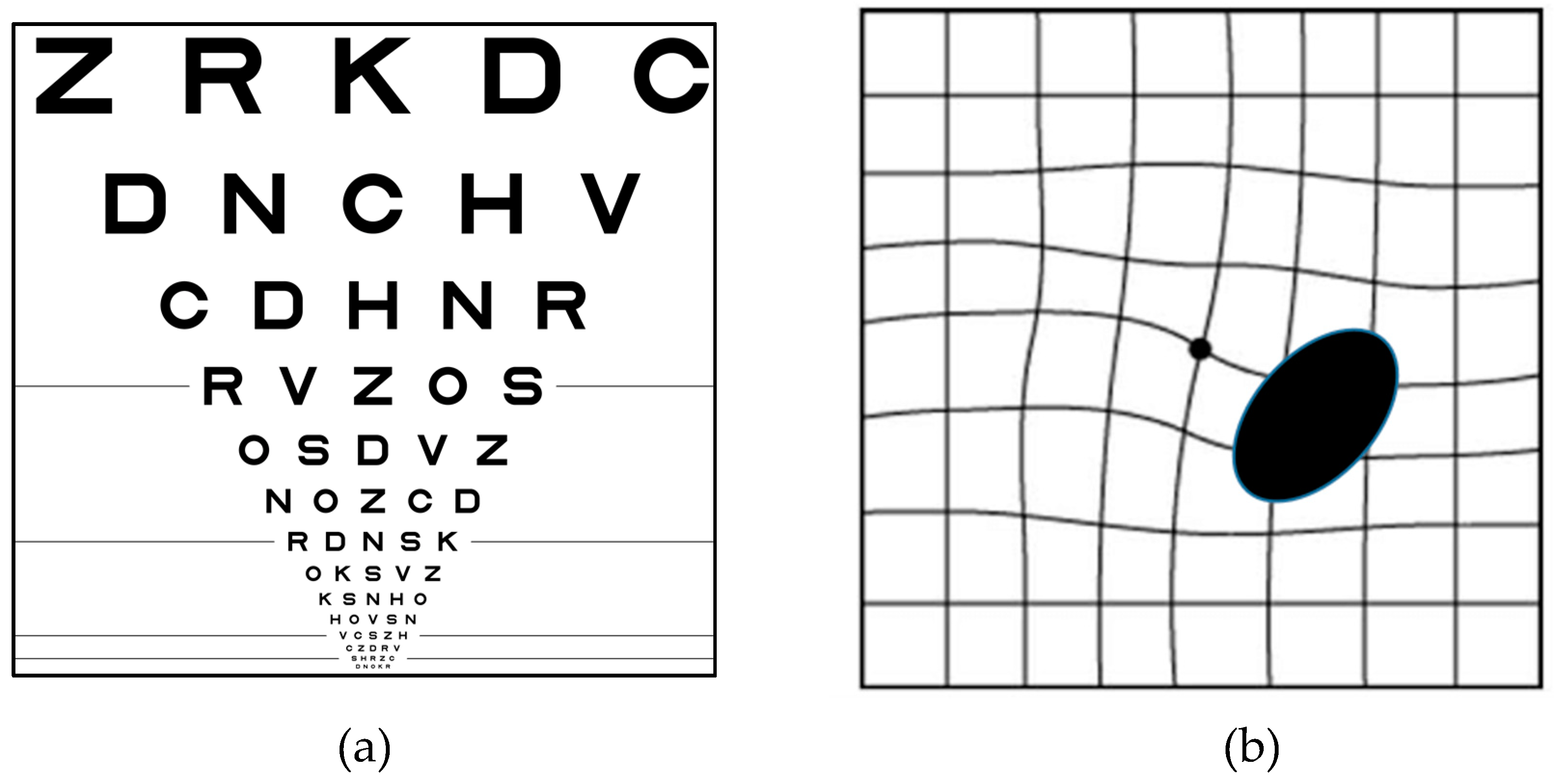 Macular Degeneration Eye Chart