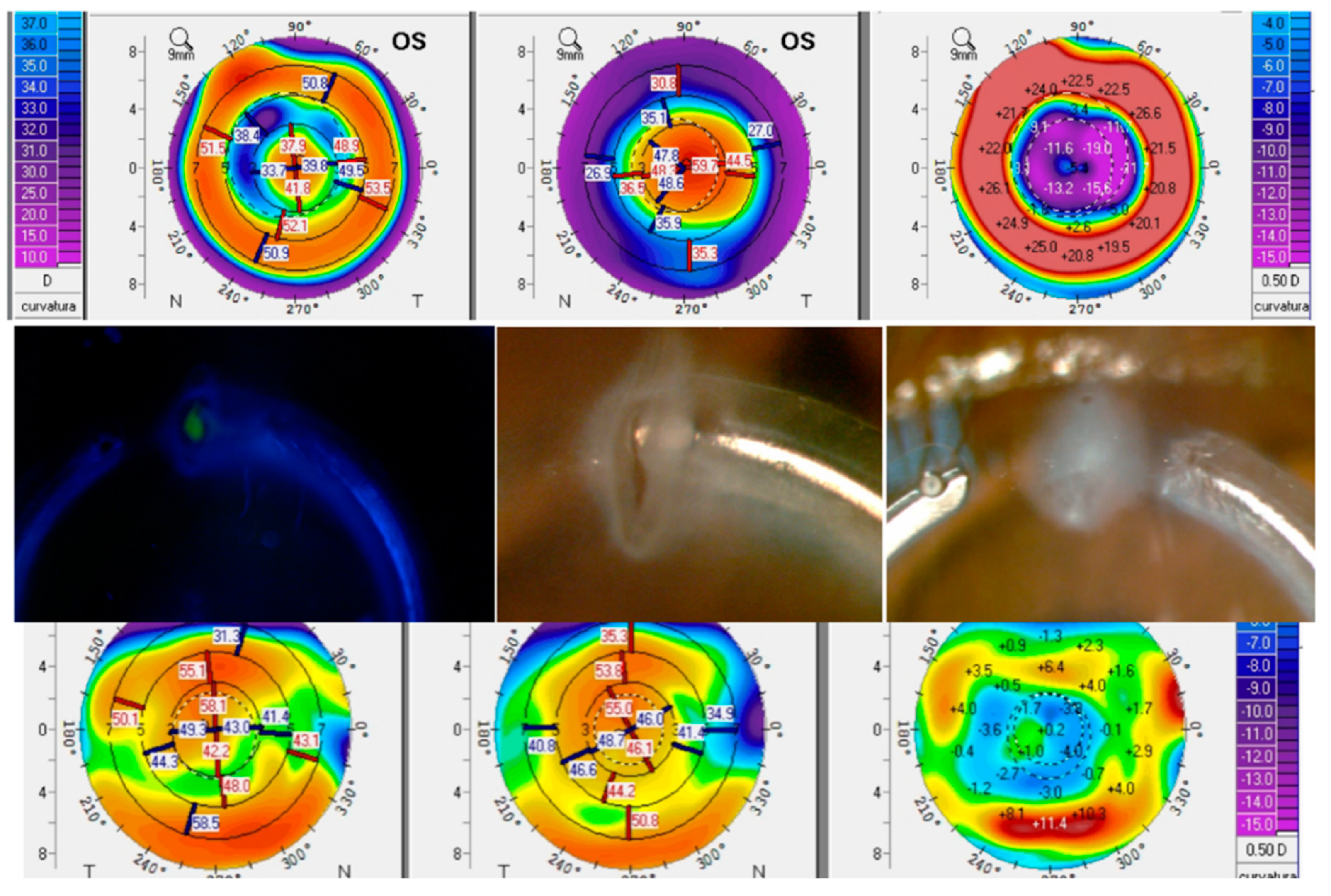 PDF] Intrastromal Corneal Ring Segment Implantation (Keraring 355°) in  Patients with Central Keratoconus: 6-Month Follow-Up | Semantic Scholar
