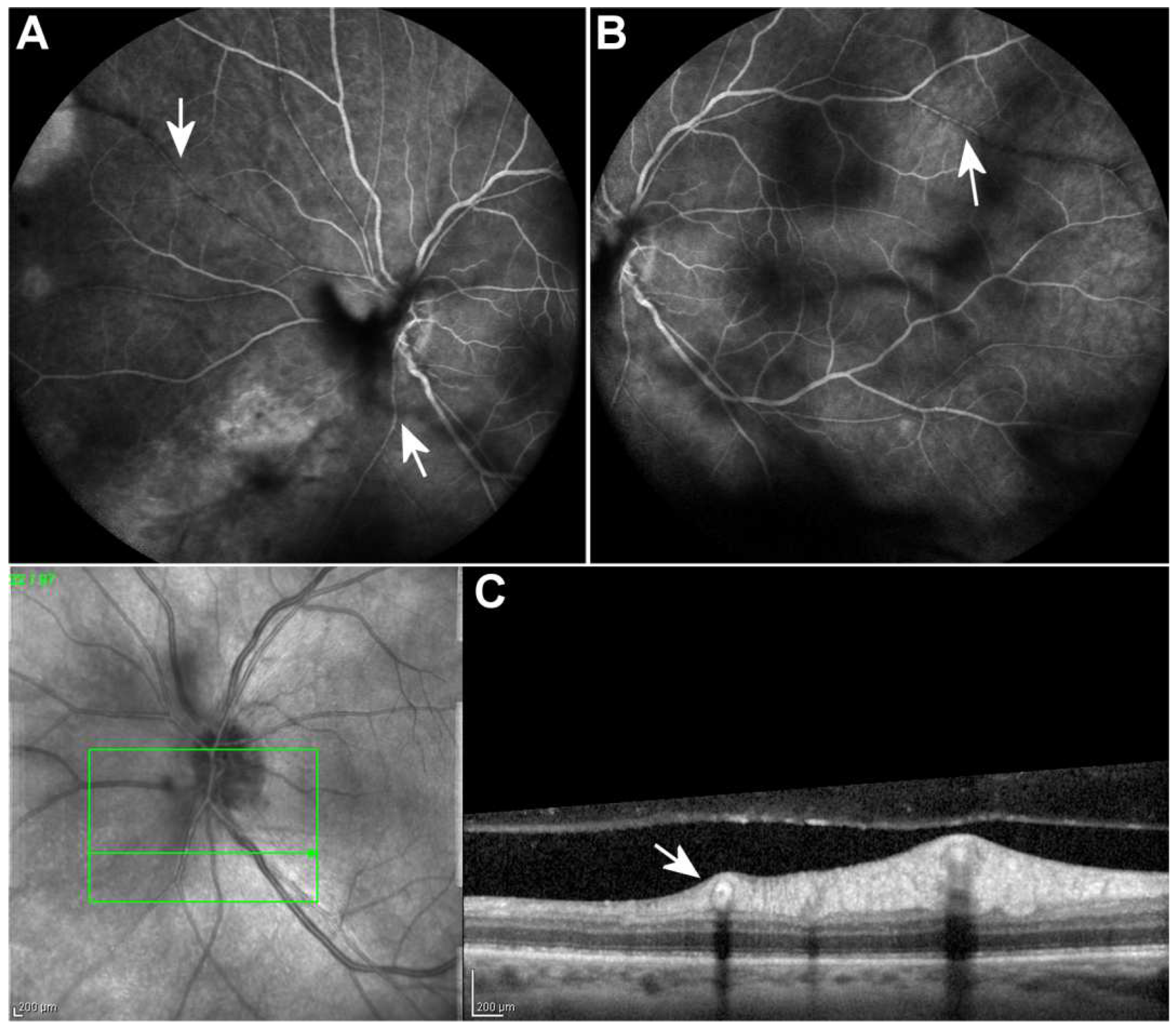 Vision Free FullText Kyrieleis Arteriolitis Associated with Acute