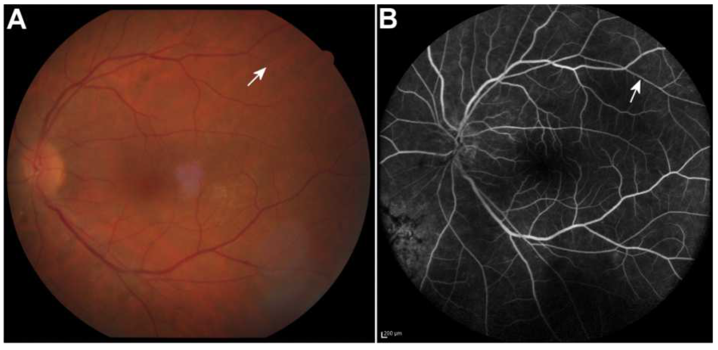 Vision Free FullText Kyrieleis Arteriolitis Associated with Acute